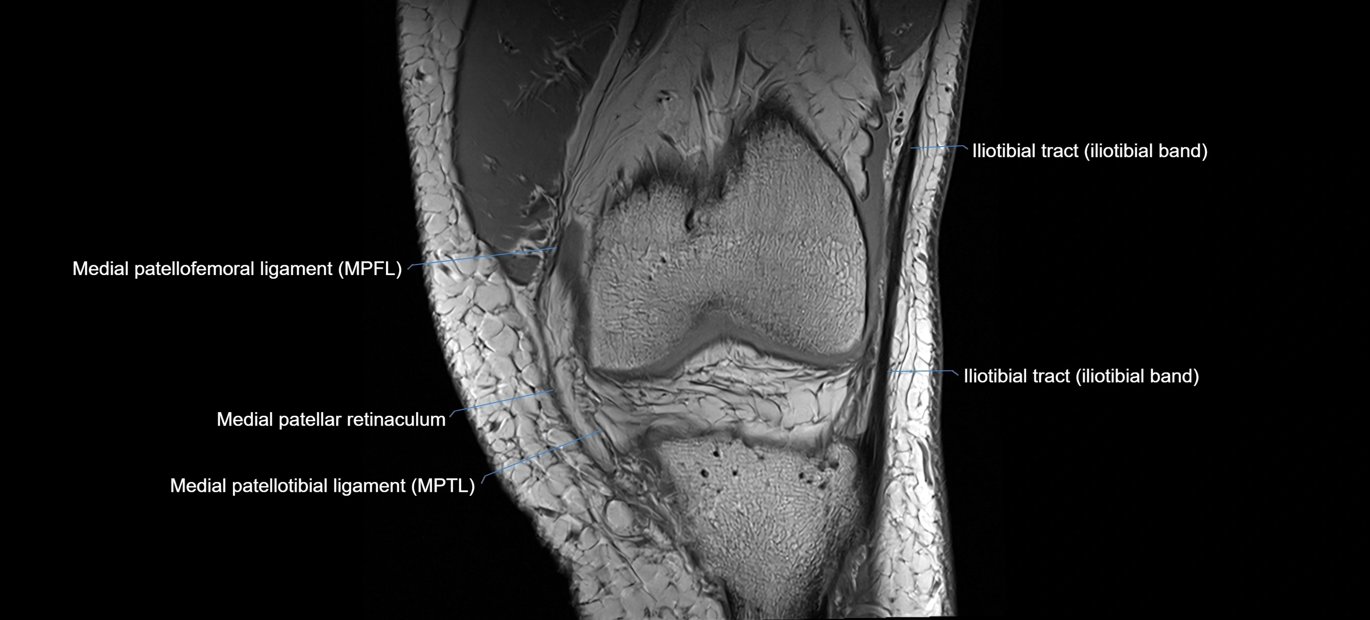 MRI coronal  ligaments cross sectional anatomy 3T  radiology  image-img-04001-00012.webp